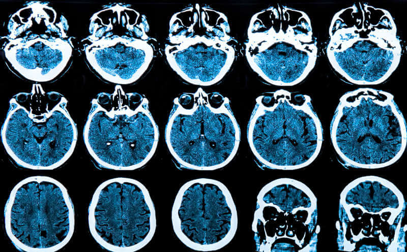 tratamiento del Alzheimer